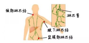 霍奇金淋巴瘤病因都有哪些呢？